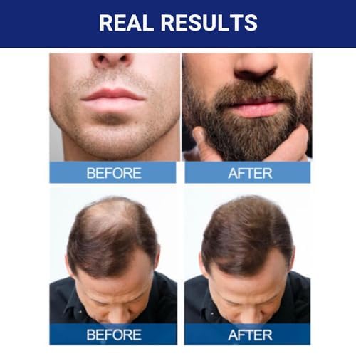 Kirkland Signature 5% Minoxidil Hair Regrowth Treatment for Men – 1 Month Supply